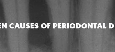 Top Ten Causes of Periodontal Disease