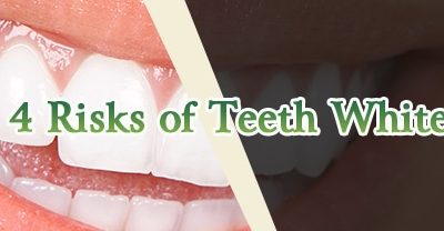 Top 4 Risks of Teeth Whitening